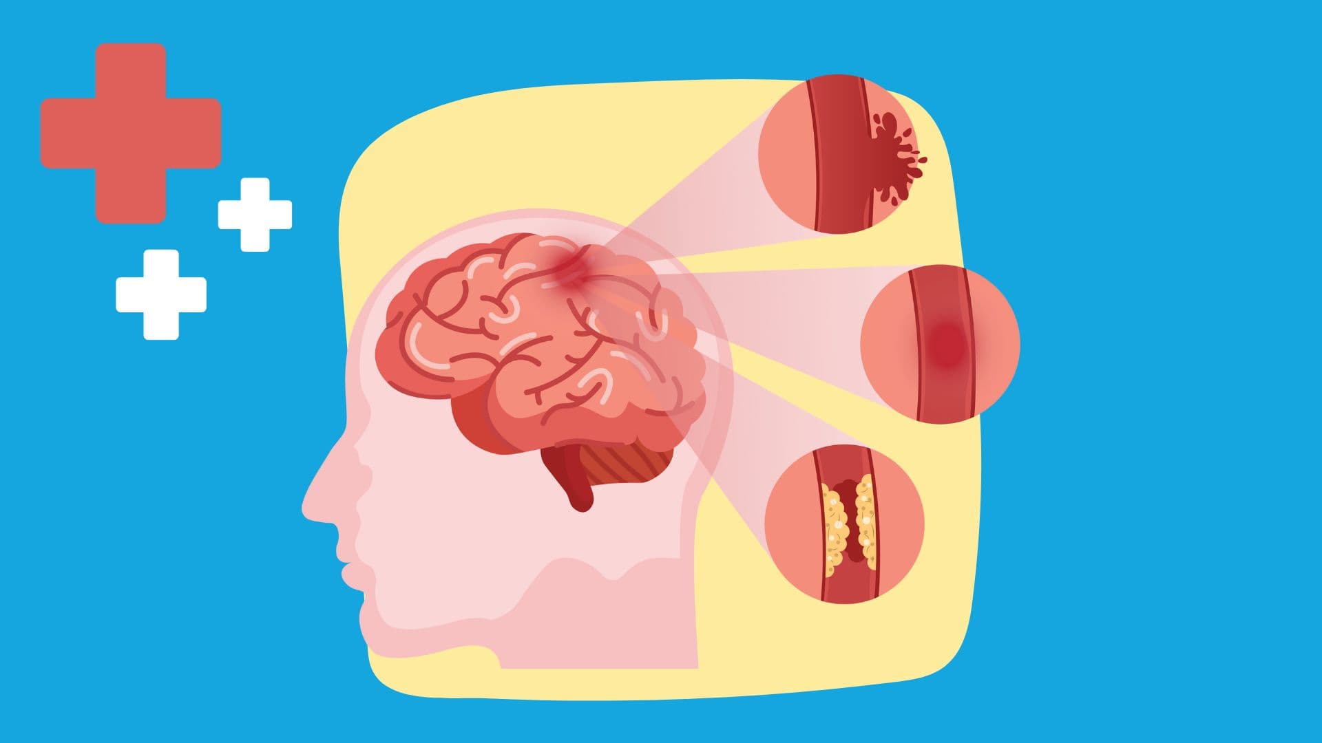 How to localize the level of lesion in strokes on the USMLE Step 1 exam